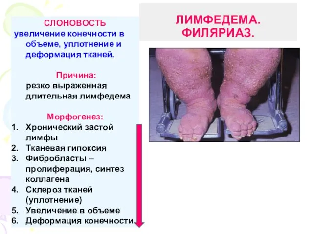 ЛИМФЕДЕМА. ФИЛЯРИАЗ. СЛОНОВОСТЬ увеличение конечности в объеме, уплотнение и деформация тканей.