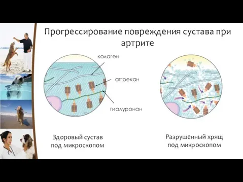 Прогрессирование повреждения сустава при артрите Здоровый сустав под микроскопом Разрушенный хрящ под микроскопом колаген гиалуронан аггрекан