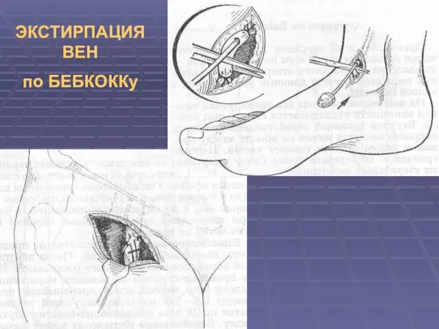 ЭКСТИРПАЦИЯ ВЕН по БЕБКОККу