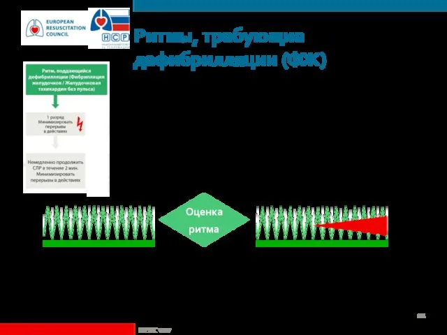 Ритмы, требующие дефибрилляции (ФЖ) ©ERC vzw Оценка ритма