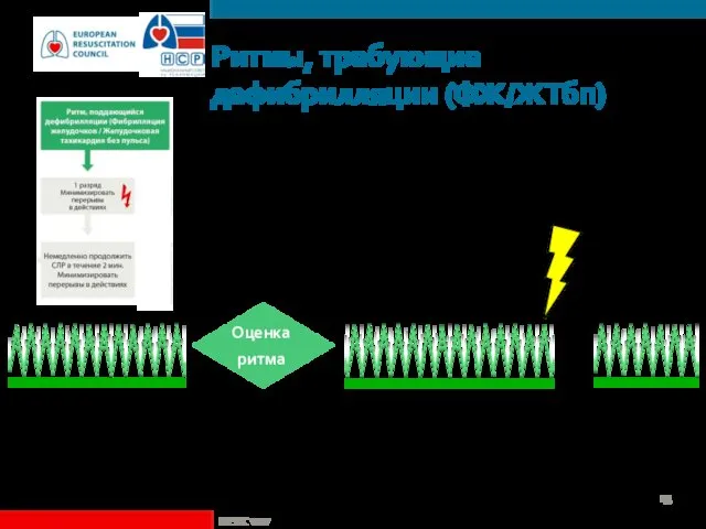 Ритмы, требующие дефибрилляции (ФЖ/ЖТбп) ©ERC vzw Оценка ритма