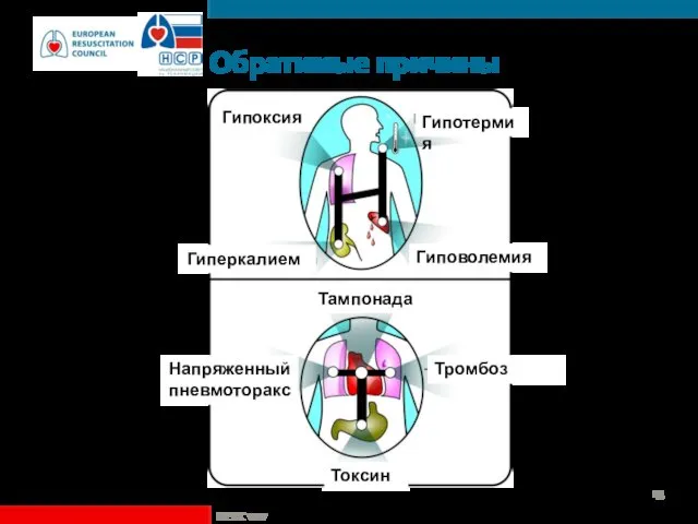 Обратимые причины ©ERC vzw Гипоксия Гипотермия Гиповолемия Гиперкалиемия Тампонада Тромбоз Токсины Напряженный пневмоторакс