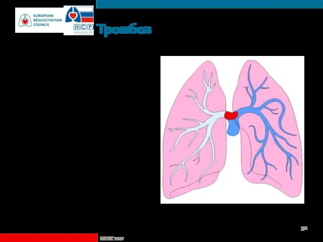 Тромбоз Применять тромболизис в случае высокой клинической вероятности ТЭЛА После проведения