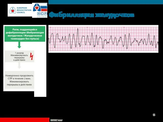 Фибрилляция желудочков Некоординированная электрическая активность Крупно- или мелковолновая Исключить артефакты Движение