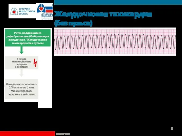 Желудочковая тахикардия (без пульса) Мономорфная ЖТ Широкие комплексы Высокая частота Постоянная