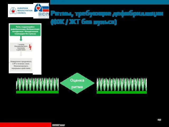 Ритмы, требующие дефибрилляции (ФЖ / ЖТ без пульса) Оценка ритма ©ERC vzw СТОП СЛР