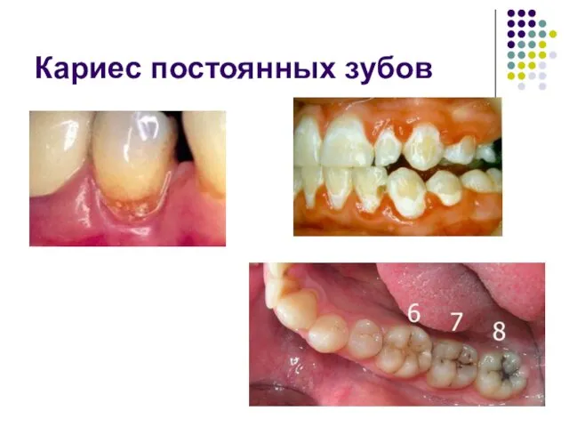 Кариес постоянных зубов