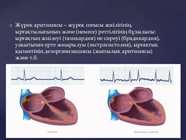 Жүрек аритмиясы – жүрек соғысы жиілігінің, ырғақтылығының және (немесе) реттілігінің бұзылысы: