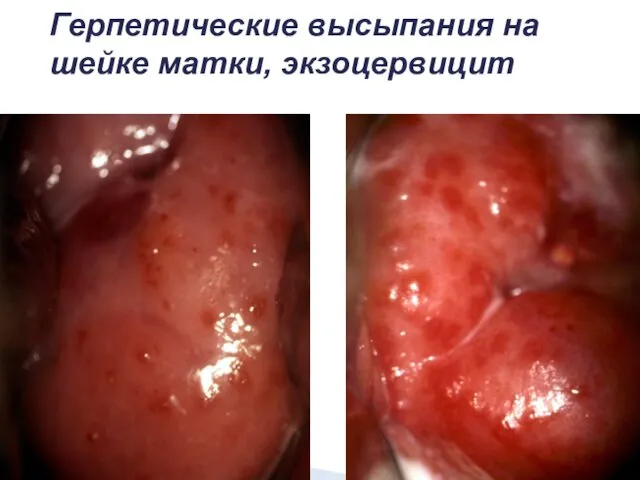 Герпетические высыпания на шейке матки, экзоцервицит