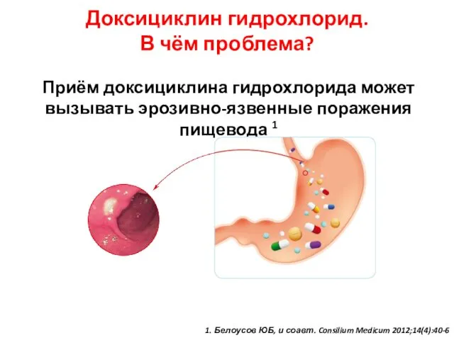 Доксициклин гидрохлорид. В чём проблема? Приём доксициклина гидрохлорида может вызывать эрозивно-язвенные