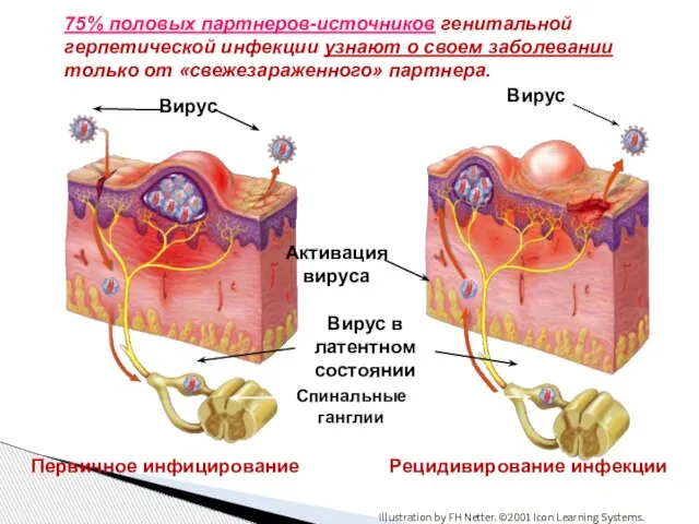 75% половых партнеров-источников генитальной герпетической инфекции узнают о своем заболевании только