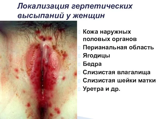 Локализация герпетических высыпаний у женщин Кожа наружных половых органов Перианальная область