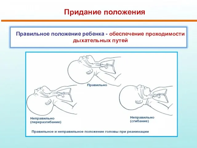 Придание положения Правильное положение ребенка - обеспечение проходимости дыхательных путей