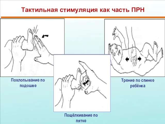 Тактильная стимуляция как часть ПРН Похлопывание по подошве Пощёлкивание по пятке Трение по спинке ребёнка