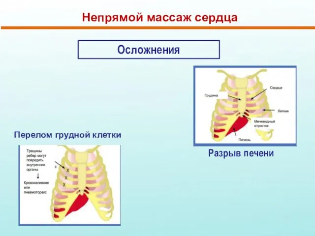 Непрямой массаж сердца Осложнения Разрыв печени Перелом грудной клетки