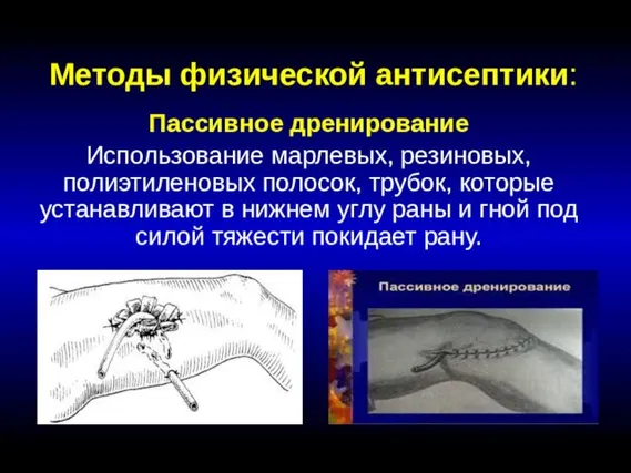 Методы физической антисептики: Пассивное дренирование Использование марлевых, резиновых, полиэтиленовых полосок, трубок,