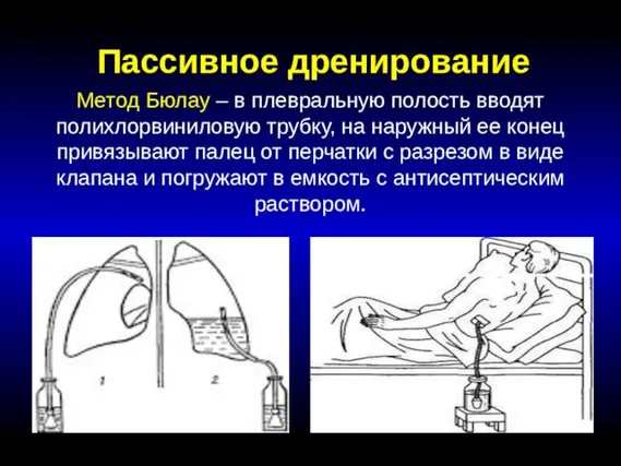 Пассивное дренирование Метод Бюлау – в плевральную полость вводят полихлорвиниловую трубку,