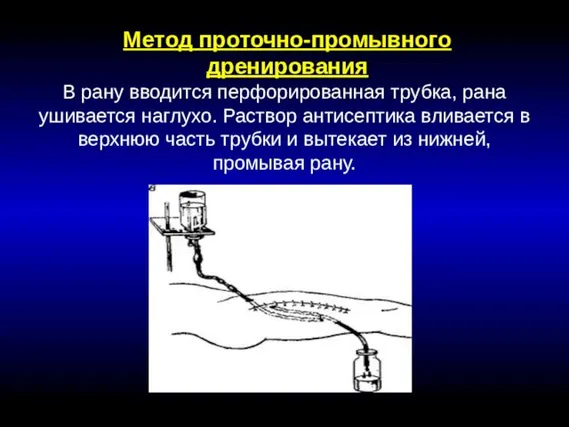 Метод проточно-промывного дренирования В рану вводится перфорированная трубка, рана ушивается наглухо.