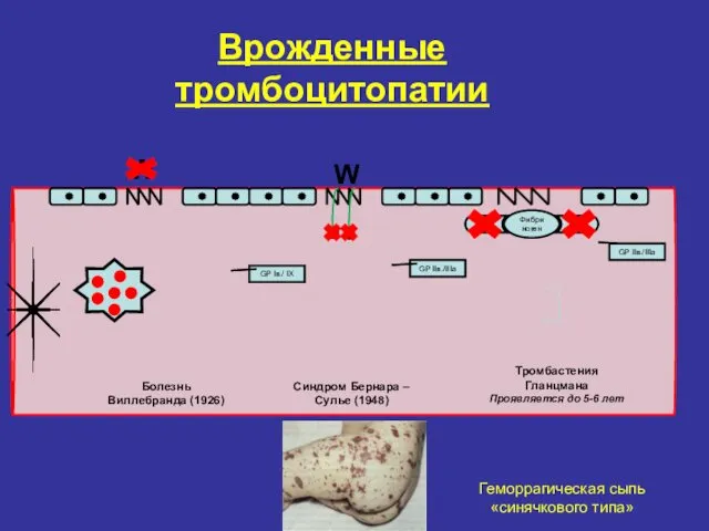 W W Фибриноген Болезнь Виллебранда (1926) Синдром Бернара – Сулье (1948)