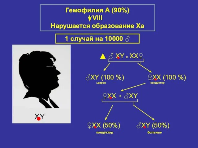 Гемофилия А (90%) VIII Нарушается образование Xа 1 случай на 10000