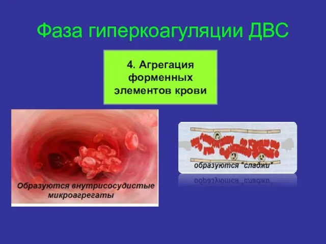 Фаза гиперкоагуляции ДВС 4. Агрегация форменных элементов крови