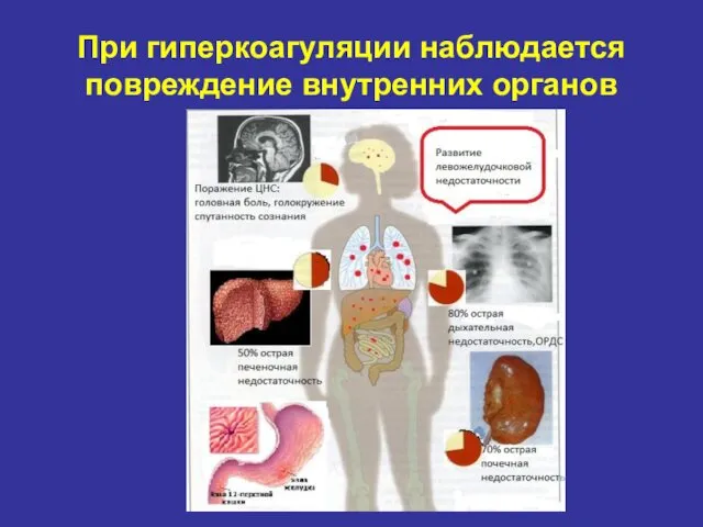 При гиперкоагуляции наблюдается повреждение внутренних органов