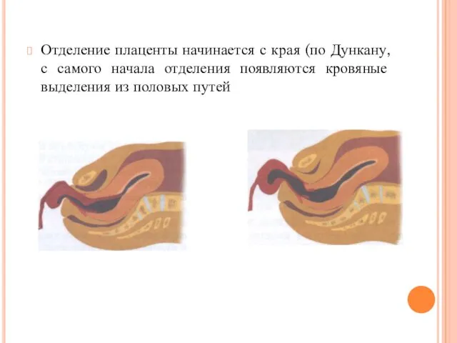 Отделение плаценты начинается с края (по Дункану, с самого начала отделения