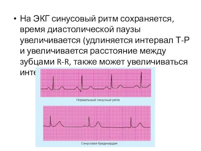 На ЭКГ синусовый ритм сохраняется, время диастолической паузы увеличивается (удлиняется интервал