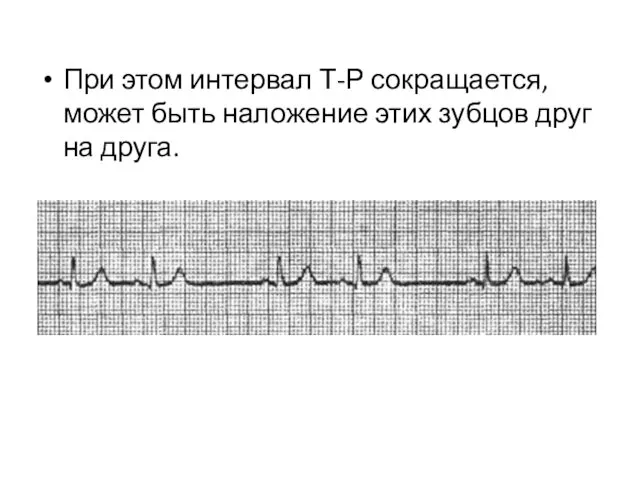 При этом интервал Т-Р сокращается, может быть наложение этих зубцов друг на друга.