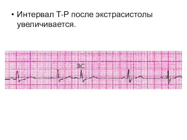 Интервал Т-Р после экстрасистолы увеличивается.