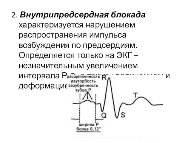 2. Внутрипредсердная блокада характеризуется нарушением распространения импульса возбуждения по предсердиям. Определяется