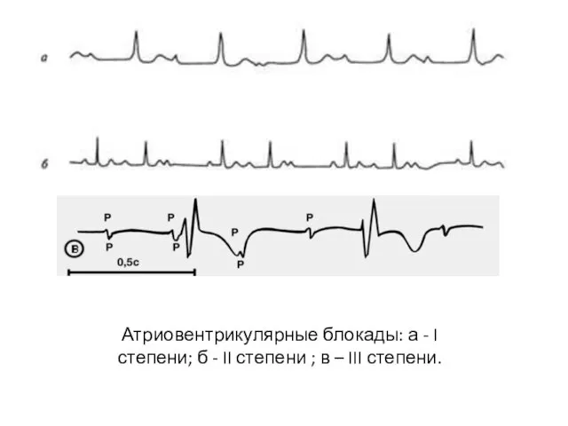 Атриовентрикулярные блокады: а - I степени; б - II степени ; в – III степени.