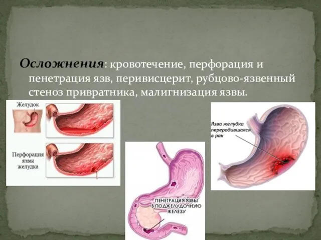 Осложнения: кровотечение, перфорация и пенетрация язв, перивисцерит, рубцово-язвенный стеноз привратника, малигнизация язвы.