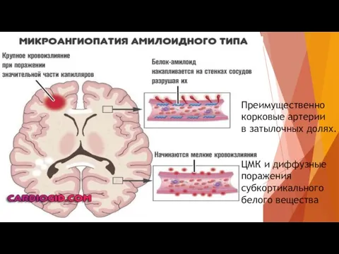 Преимущественно корковые артерии в затылочных долях. ЦМК и диффузные поражения субкортикального белого вещества