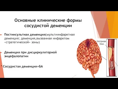 Основные клинические формы сосудистой деменции Постинсультная деменция(мультиинфарктная деменция; деменция,вызванная инфарктом «стратегической»