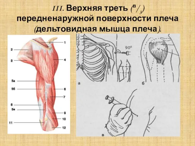 III. Верхняя треть (в/3) передненаружной поверхности плеча (дельтовидная мышца плеча).