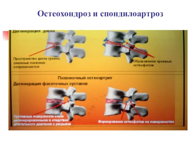 Остеохондроз и спондилоартроз