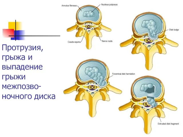 Протрузия, грыжа и выпадение грыжи межпозво-ночного диска