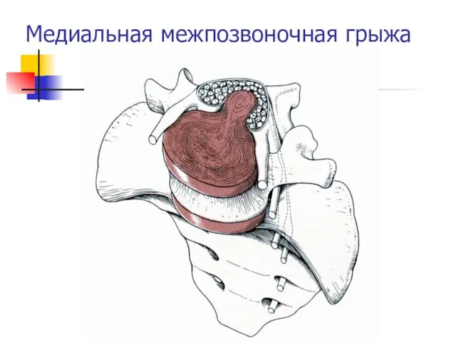 Медиальная межпозвоночная грыжа