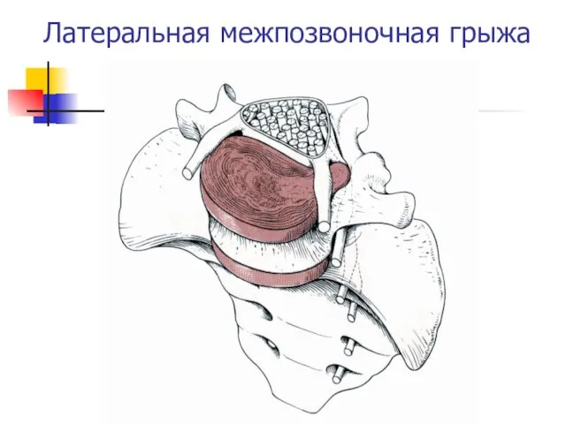 Латеральная межпозвоночная грыжа