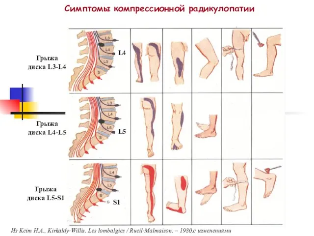 Симптомы компрессионной радикулопатии Из Keim H.A., Kirkaldy-Willis. Les lombalgies / Rueil-Malmaison.