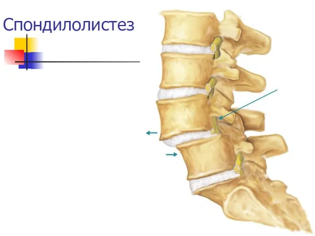 Спондилолистез