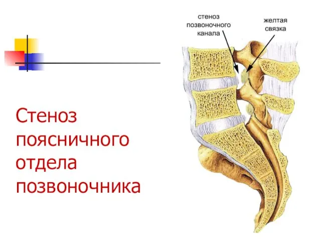 Стеноз поясничного отдела позвоночника