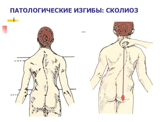 ПАТОЛОГИЧЕСКИЕ ИЗГИБЫ: СКОЛИОЗ