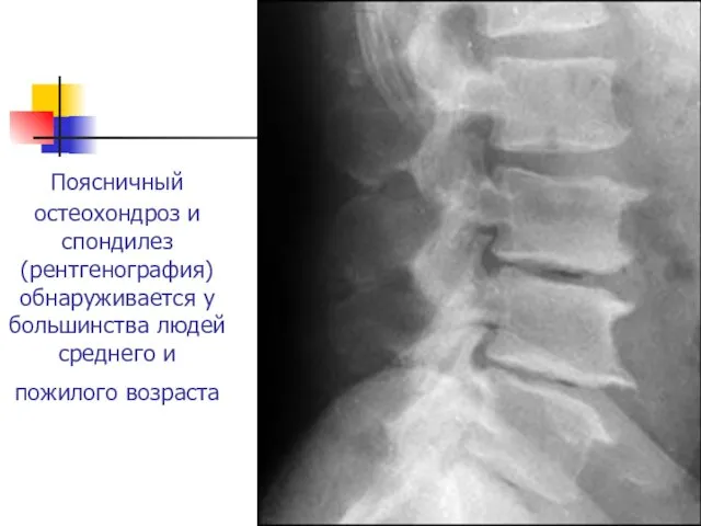 Поясничный остеохондроз и спондилез (рентгенография) обнаруживается у большинства людей среднего и пожилого возраста