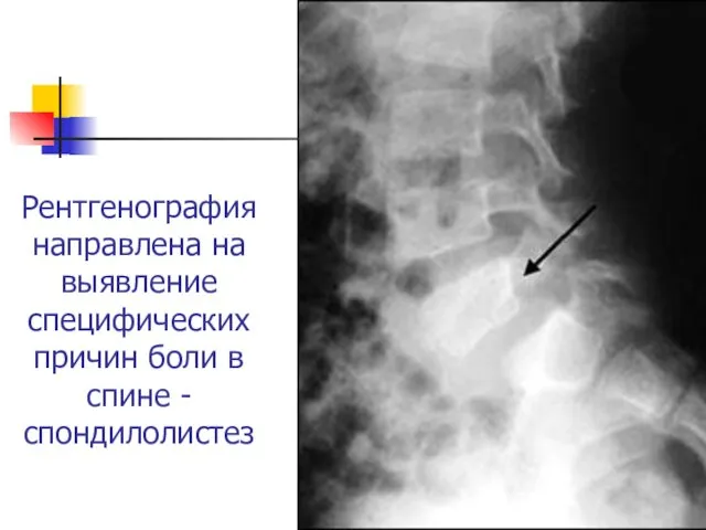 Рентгенография направлена на выявление специфических причин боли в спине - спондилолистез