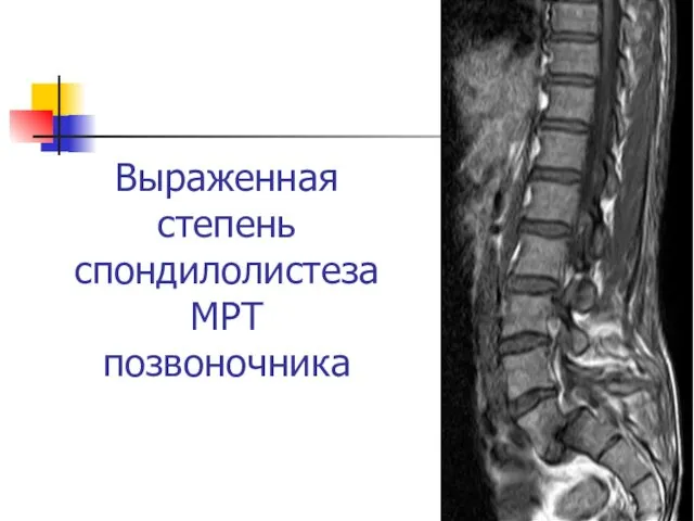 Выраженная степень спондилолистеза МРТ позвоночника