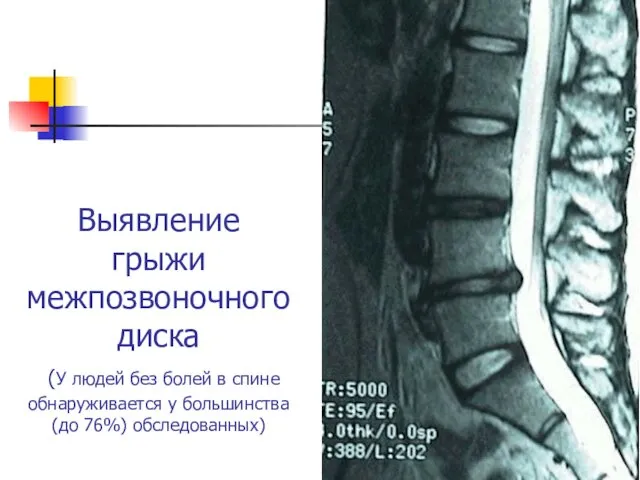 Выявление грыжи межпозвоночного диска (У людей без болей в спине обнаруживается у большинства (до 76%) обследованных)