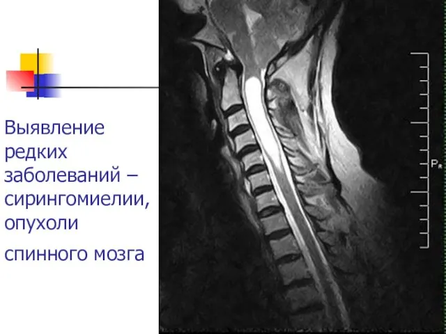 Выявление редких заболеваний – сирингомиелии, опухоли спинного мозга