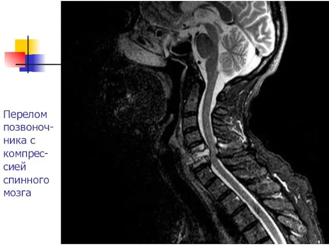 Перелом позвоноч-ника с компрес-сией спинного мозга